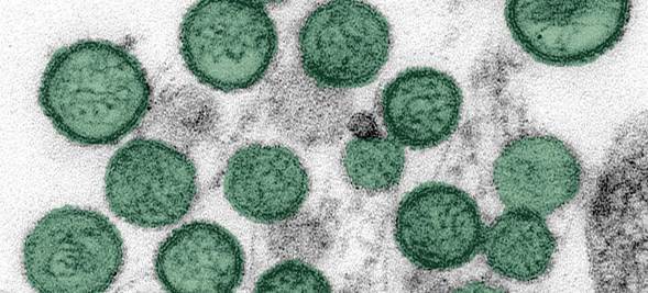 Brote de Hantavirus en crucero: otro pasajero contrae la enfermedad